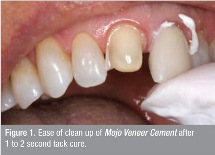MOJO Veneer Cement (2 yr) – The Dental Advisor